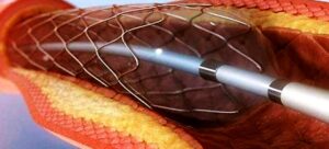 Trans-Luminal Coronary Angioplasty (PTCA) - My Blog